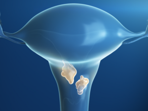 Gebärmutterhals mit Tumor